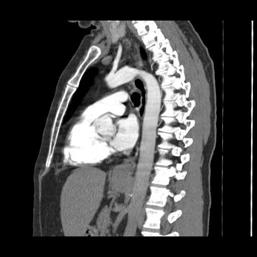 File:Bronchogenic carcinoma (Radiopaedia 47026-51562 Sagittal C+ CTPA 19).jpg