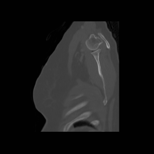 Bronchogenic carcinoma (Radiopaedia 73497-84262 Sagittal bone window 139).jpg