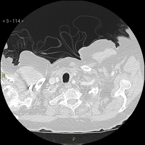 Bronchogenic carcinoma as an incidental finding (Radiopaedia 16453-16130 Axial lung window 114).jpg