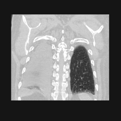 File:Bronchogenic carcinoma with metastatic lymphadenopathy (Radiopaedia 37671-39569 Coronal lung window 40).jpg