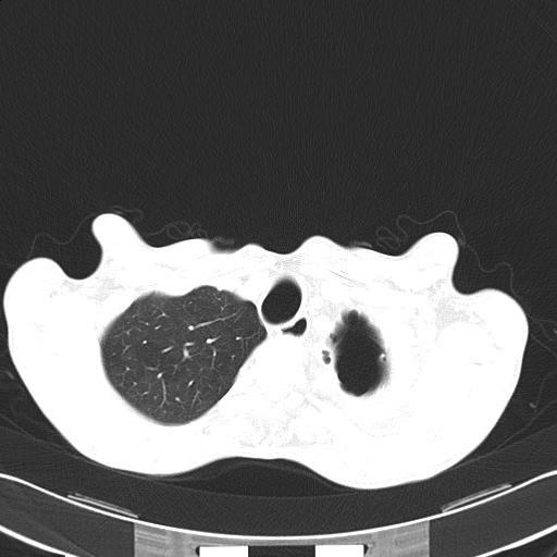 Bronchopleural fistula secondary to tuberculosis (Radiopaedia 20415-20322 Axial lung window 11).jpg