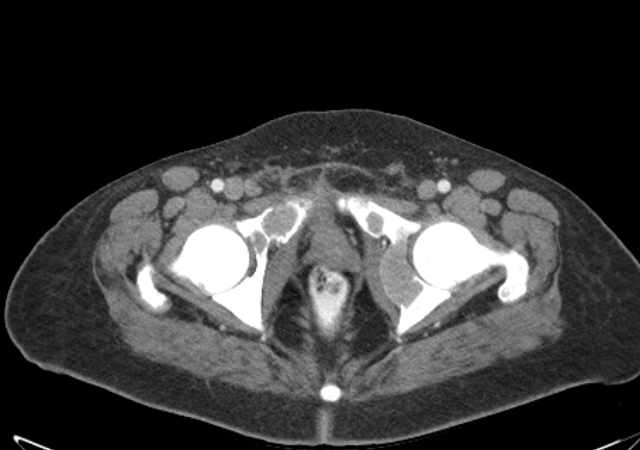 Brown tumors compressing the spinal cord (Radiopaedia 68442-77988 E 122).jpg