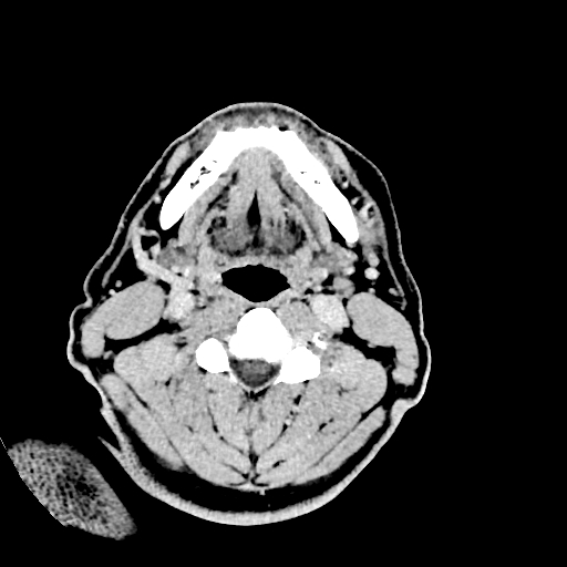 Buccal fat pad arteriovenous malformation (Radiopaedia 70936-81142 Axial non-contrast 6).jpg