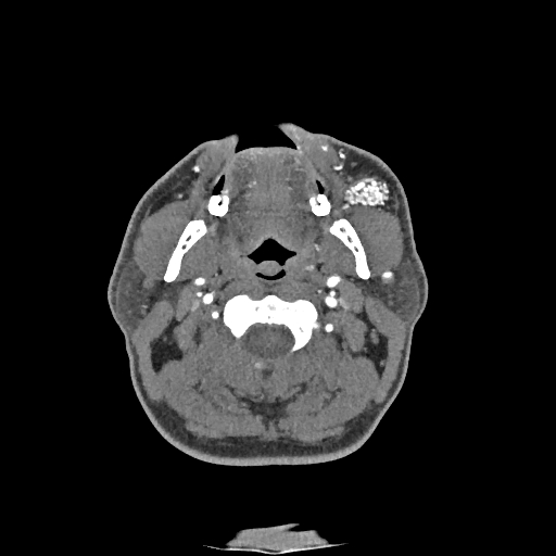 Buccal fat pad arteriovenous malformation (Radiopaedia 70936-81144 D 189).jpg