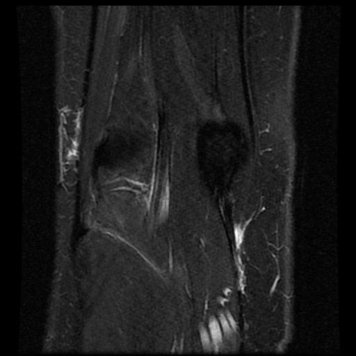 File:Bucket handle meniscus tear (Radiopaedia 56916-63751 Coronal STIR 17).jpg