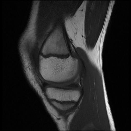 File:Bucket handle tear - lateral meniscus (Radiopaedia 72124-82634 Sagittal T1 12).jpg