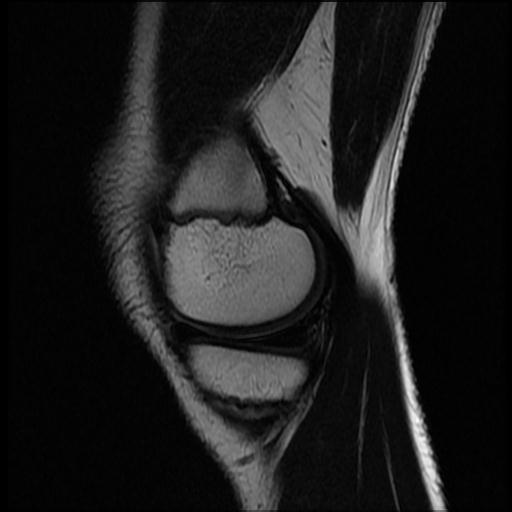 File:Bucket handle tear - lateral meniscus (Radiopaedia 72124-82634 Sagittal T2 13).jpg