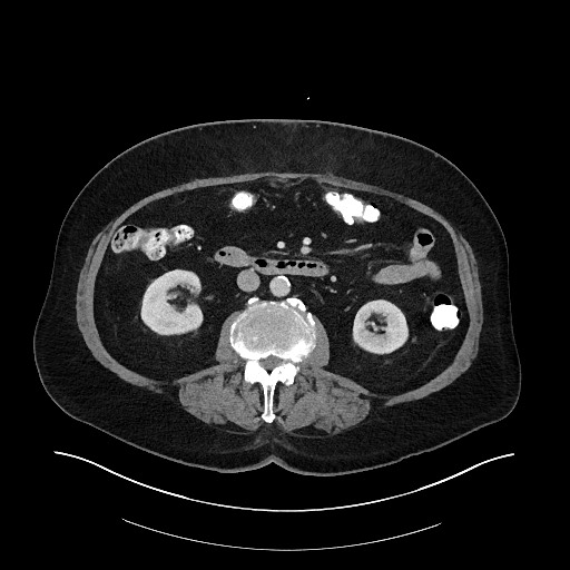 Buried bumper syndrome - gastrostomy tube (Radiopaedia 63843-72575 A 38).jpg
