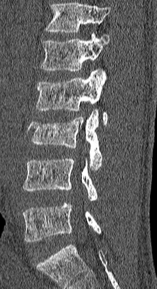 Burst fracture (Radiopaedia 53373-59357 Sagittal bone window 49).jpg