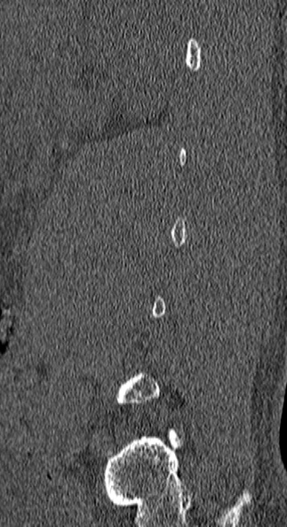 Burst fracture (Radiopaedia 53373-59357 Sagittal bone window 74).jpg