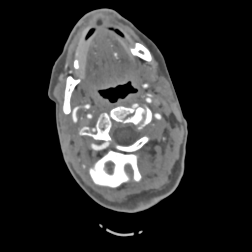 File:C2 fracture with vertebral artery dissection (Radiopaedia 37378-39200 A 171).png