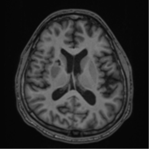 CNS vasculitis (Radiopaedia 55715-62263 Axial T1 39).png