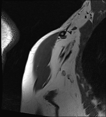 File:Calcific tendinitis of the infraspinatus tendon (Radiopaedia 87256-103537 Coronal T1 2).jpg