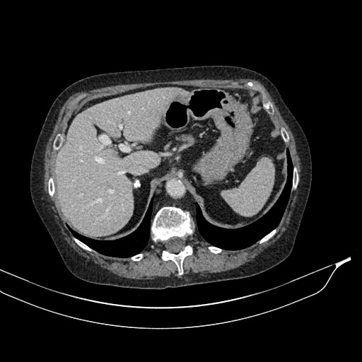 Calcified adrenal glands and Spigelian hernia (Radiopaedia 49741-54988 A 48).jpg