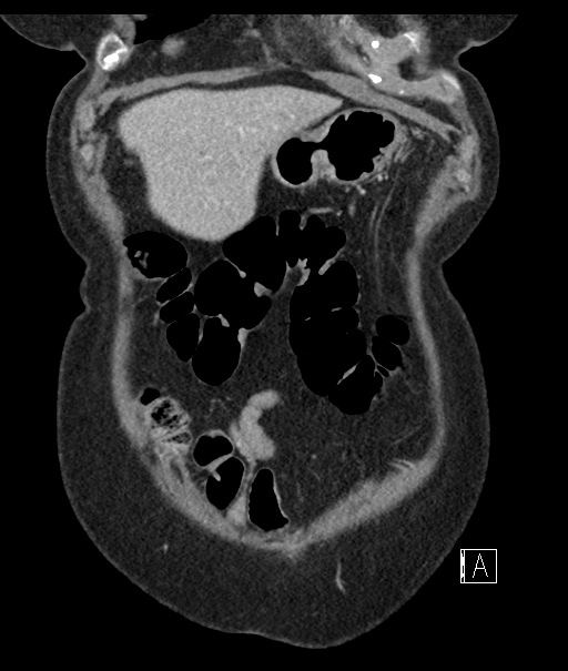 Calcified adrenal glands and Spigelian hernia (Radiopaedia 49741-54988 B 19).jpg