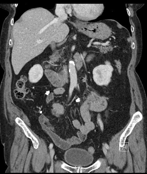 Calcified adrenal glands and Spigelian hernia (Radiopaedia 49741-54988 B 51).jpg
