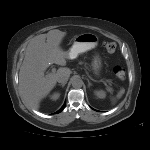File:Calcified hepatic hydatid cyst (Radiopaedia 18907-18853 Axial non-contrast 15).jpg