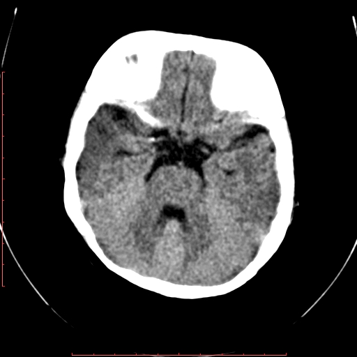 File:Calcified middle cerebral artery embolism (Radiopaedia 78949-91860 Axial non-contrast 8).jpg