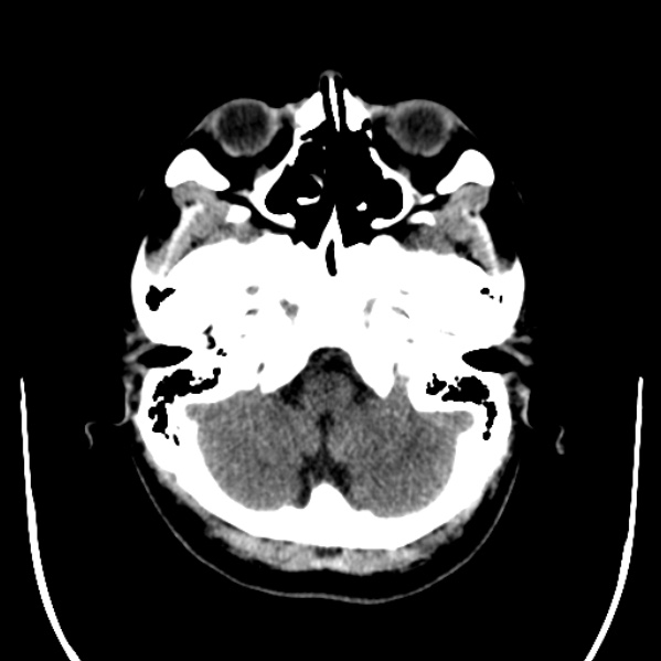 Calvarial osteoma (Radiopaedia 36520-38079 Axial non-contrast 10).jpg