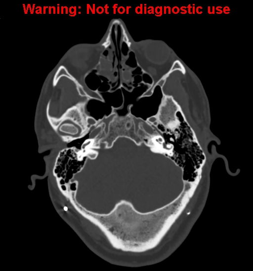 Calvarial thickening from chronic shunting (Radiopaedia 60079-67637 Axial bone window 36).jpg