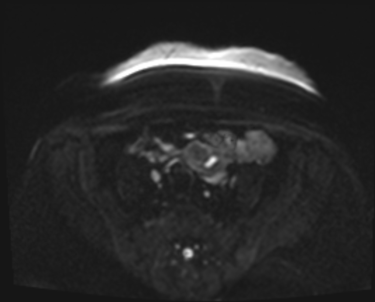 Cancer cervix - stage IIb (Radiopaedia 75411-86615 Axial DWI 25).jpg