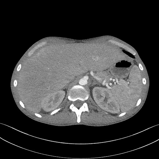 Cannonball metastases - testicular choriocarcinoma (Radiopaedia 84510-99891 B 105).jpg
