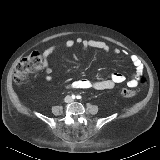 Cannonball metastases from endometrial cancer (Radiopaedia 42003-45031 E 47).png