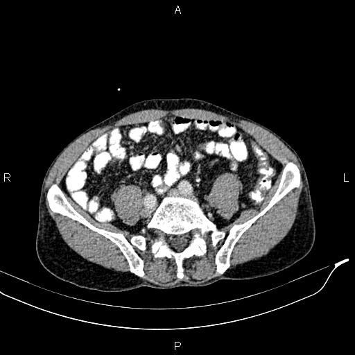 Caput medusae sign - portal hypertension (Radiopaedia 64007-72759 A 68).jpg