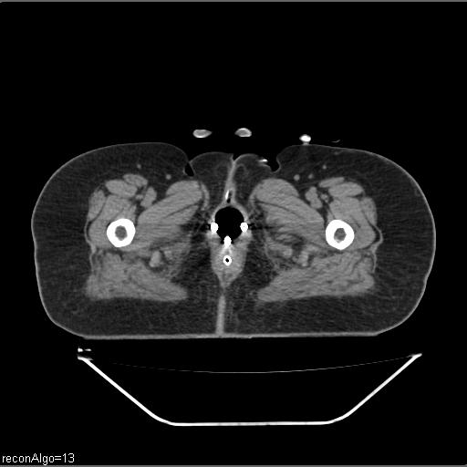 File:Carcinoma cervix- brachytherapy applicator (Radiopaedia 33135-34173 Axial non-contrast 54).jpg