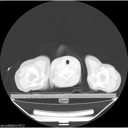 File:Carcinoma of esophagus (Radiopaedia 27356-27550 Axial lung window 35).jpg