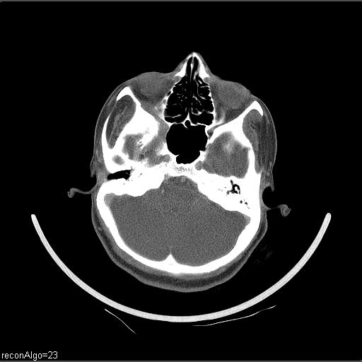 File:Carcinoma of the maxillary antrum (Radiopaedia 53805-59888 Axial C+ delayed 61).jpg