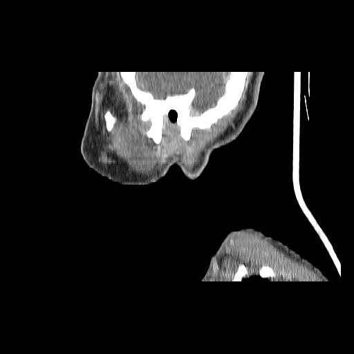 Carcinoma of the maxillary antrum (Radiopaedia 53805-59888 Sagittal C+ delayed 32).jpg