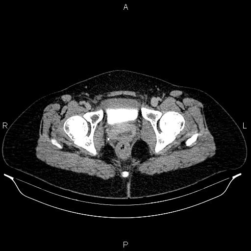 File:Carcinoma of uterine cervix (Radiopaedia 85861-101700 Axial C+ delayed 88).jpg