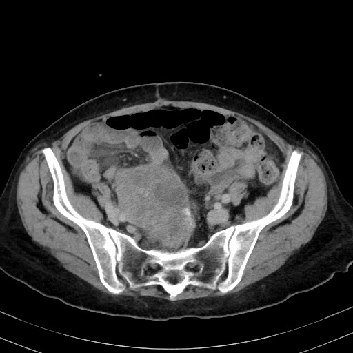 Carcinosarcoma (Radiopaedia 70401-80503 A 49).jpg