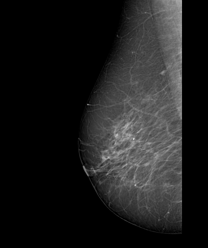 File:Cardiac pacemaker (mammography) (Radiopaedia 72298-82831 R MLO 1).PNG
