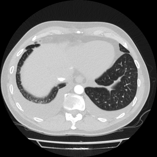 File:Cardiac tamponade (Radiopaedia 78607-91368 Axial lung window 78).jpg