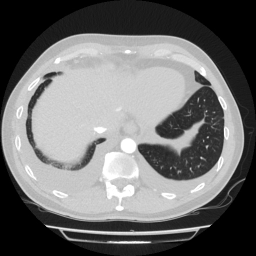 Cardiac tamponade (Radiopaedia 78607-91368 Axial lung window 79).jpg