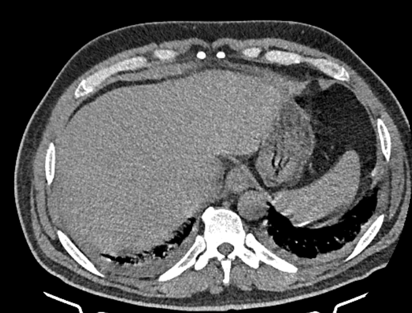 Cardiogenic pulmonary edema (Radiopaedia 68180-77678 Axial non-contrast 47).jpg
