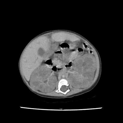 File:Caroli disease with autosomal recessive polycystic kidney disease (ARPKD) (Radiopaedia 89651-106703 B 107).jpg
