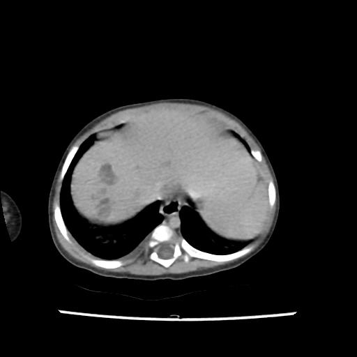 Caroli disease with autosomal recessive polycystic kidney disease (ARPKD) (Radiopaedia 89651-106703 B 21).jpg