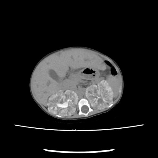 File:Caroli disease with autosomal recessive polycystic kidney disease (ARPKD) (Radiopaedia 89651-106703 E 90).jpg