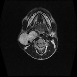 File:Carotid body tumor (Radiopaedia 30208-30823 Axial T2 9).jpg