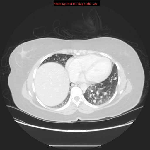 Carotid body tumor with lung metastases (Radiopaedia 9301-48390 Axial lung window 49).jpg