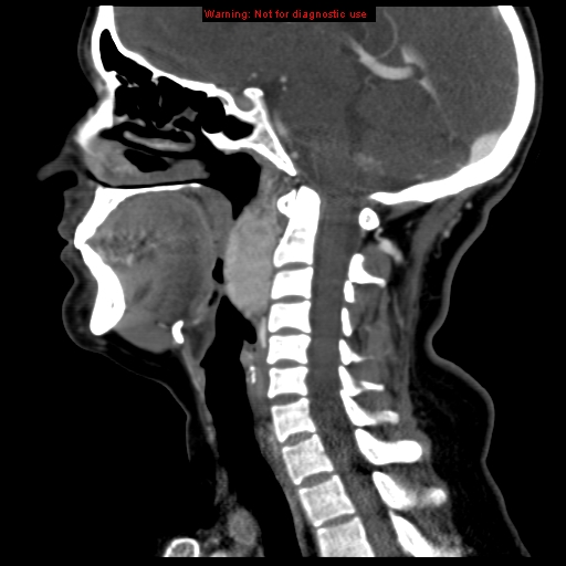Carotid body tumor with lung metastases (Radiopaedia 9301-9986 Sagittal C+ delayed 26).jpg