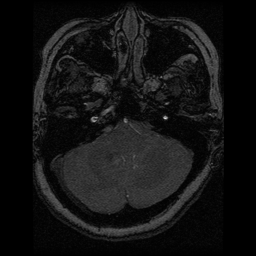 Cavernoma, DVA and right ICA aneurysm (Radiopaedia 33890-35072 E 87).png