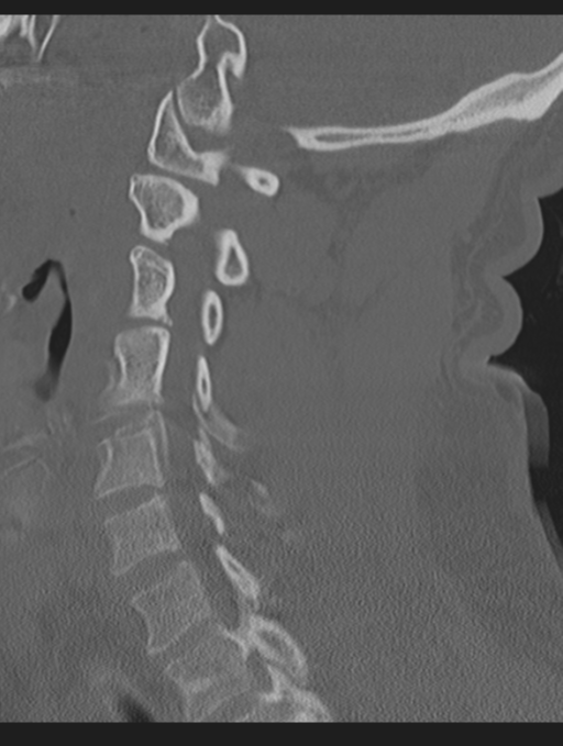 Cavernoma of cervical cord (Radiopaedia 50838-56346 Sagittal bone window 49).png