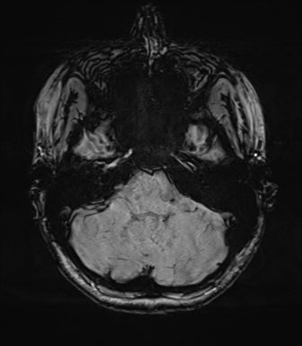 File:Cavernoma with bleed - midbrain (Radiopaedia 54546-60773 Axial SWI 12).png