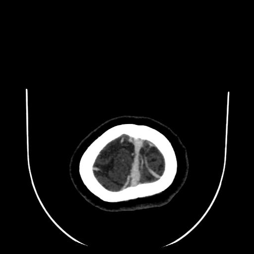 Cavernoma with developmental venous anomaly (Radiopaedia 22470-22506 C 194).jpg