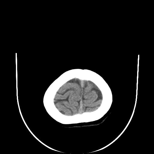 File:Cavernoma with developmental venous anomaly (Radiopaedia 22470-22506 non-contrast 32).jpg
