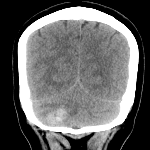 Cavernoma with hemorrhage (Radiopaedia 70755-80931 Coronal non-contrast 48).png